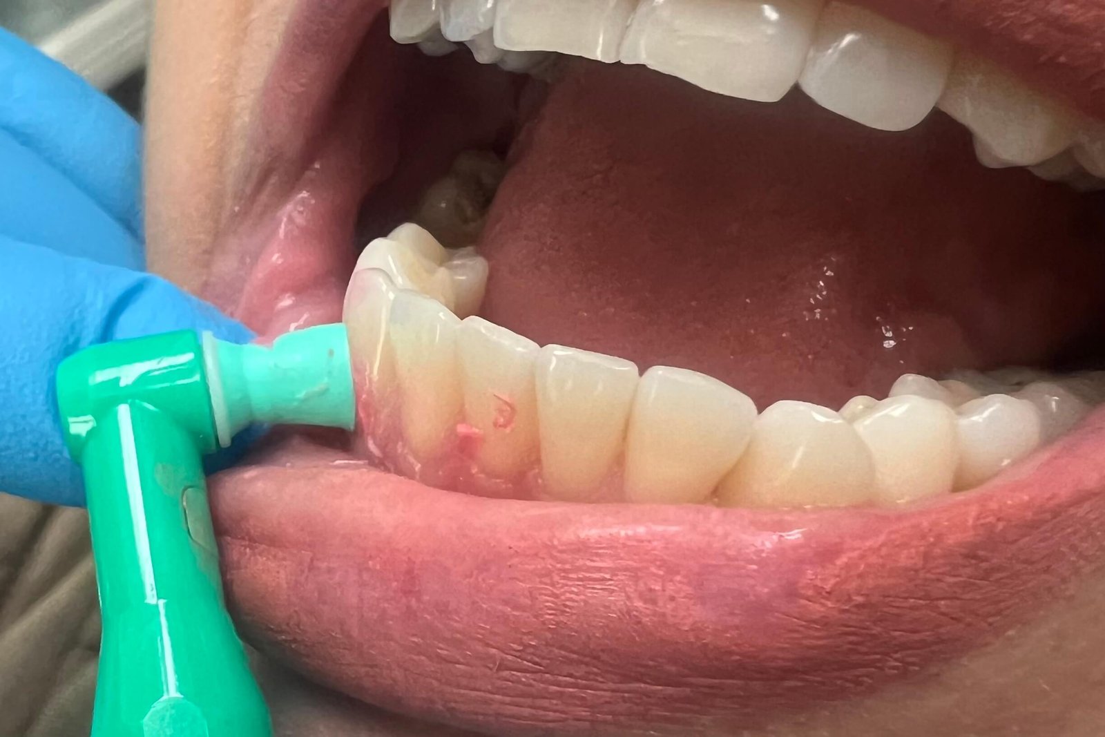 Teeth Cleaning
