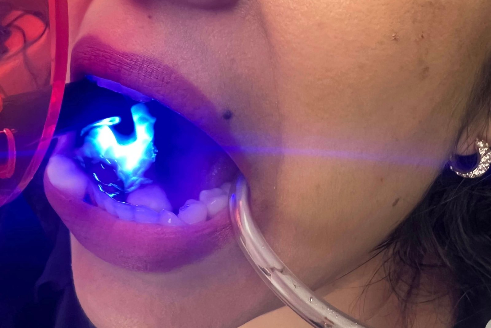 Dental Crowns