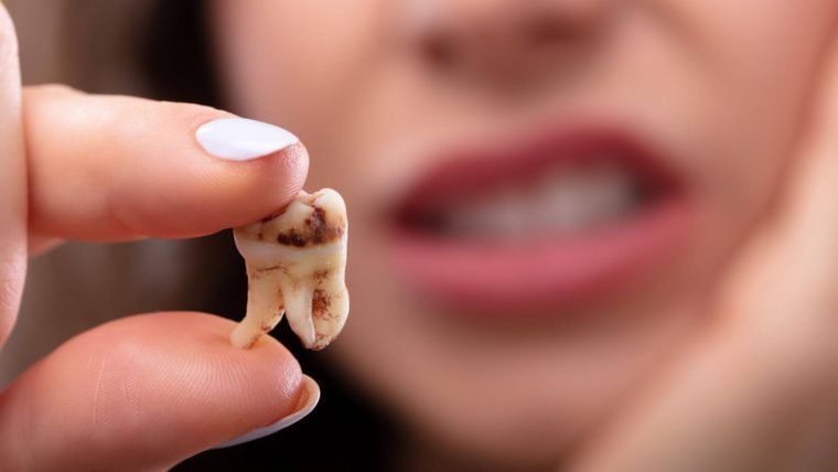 Visual signs of tooth decay at different stages.