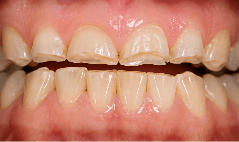 Close-up of flattened and chipped front teeth showing visible enamel wear caused by bruxism