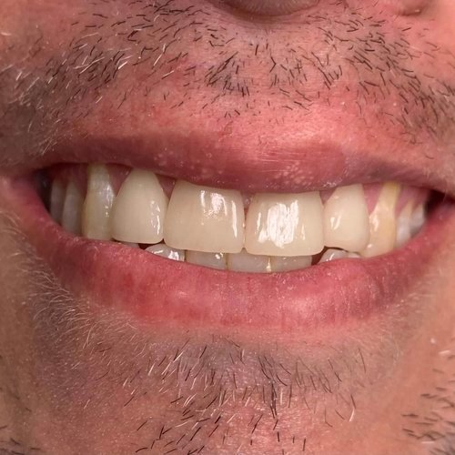 Close-up of a restored smile with dental crowns.