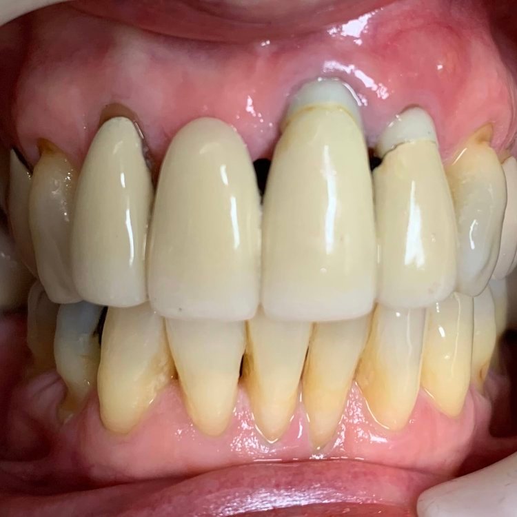 Fixed dental implant bridge restoring missing teeth.