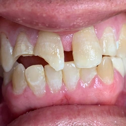 Close-up of two broken teeth before dental crown restoration.