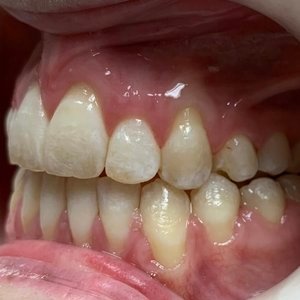 Side view after photo of an open bite orthodontic case, showing corrected alignment