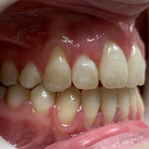 Side view after photo of an open bite orthodontic case, showing corrected alignment