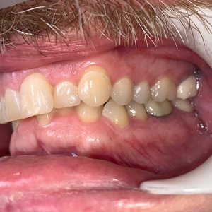 Misaligned teeth before getting orthodontic braces.