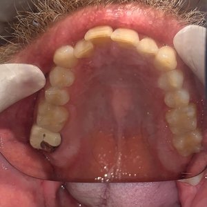 Misaligned upper teeth before orthodontic correction.