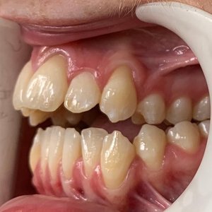 Side view of an open bite case before orthodontic treatment