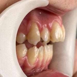 Side view of an open bite case before orthodontic treatment