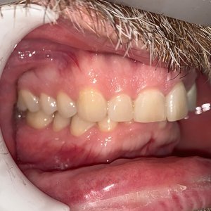 Misaligned teeth before orthodontic braces.