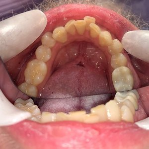 Misaligned teeth before orthodontic braces treatment.