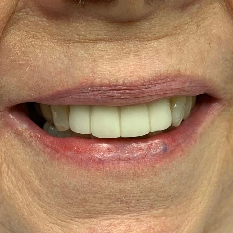 Fixed dental implant bridge restoring missing teeth.