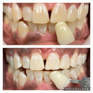 Teeth-whitening-Before-and-After