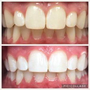 before-after-Teeth-Whitening-allen-texas
