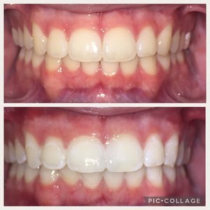 before-after-Teeth-Whitening-treatment