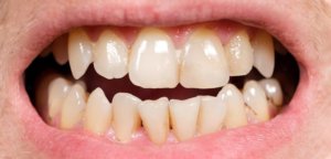 Night guard preventing damage from teeth grinding.
