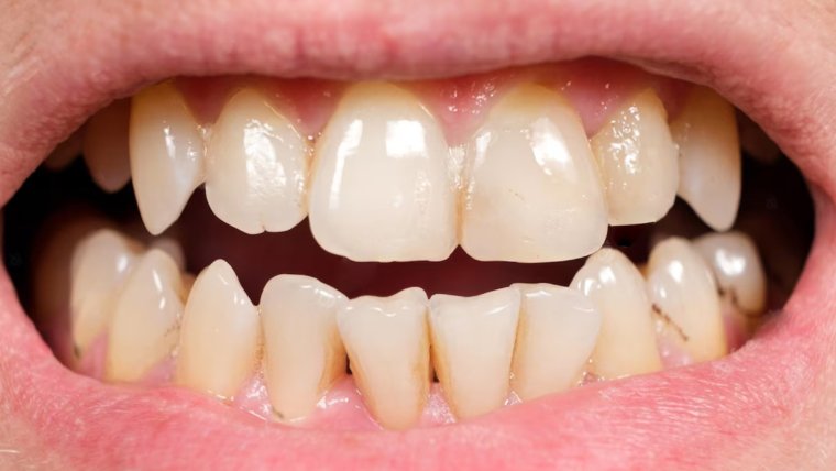 Wear A Night Guard To Save Your Teeth From The Damage Of Teeth Grinding