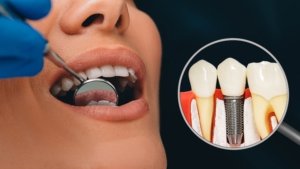 Durable and natural-looking dental implants for missing teeth.