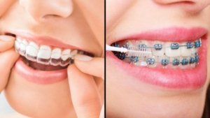 Comparison of Invisalign and braces for orthodontic treatment.