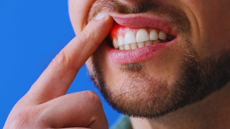 Unlocking the Truth about Gum Grafting