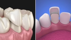 Comparison of dental crowns and veneers for smile restoration.