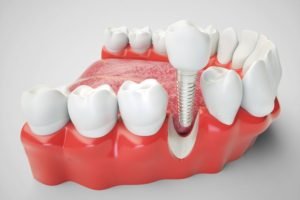 Permanent tooth replacement with dental implants.
