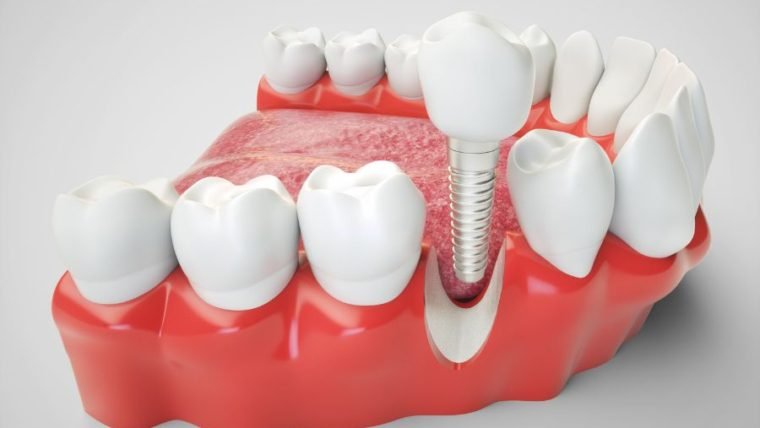 Should You Consider a Dental Implant after a Failed Root Canal in Allen, Texas?