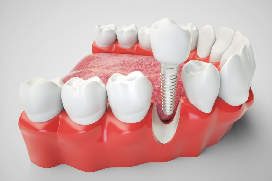 Permanent tooth replacement with dental implants.