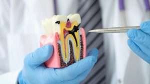 Appearance of small cavities and early tooth decay.