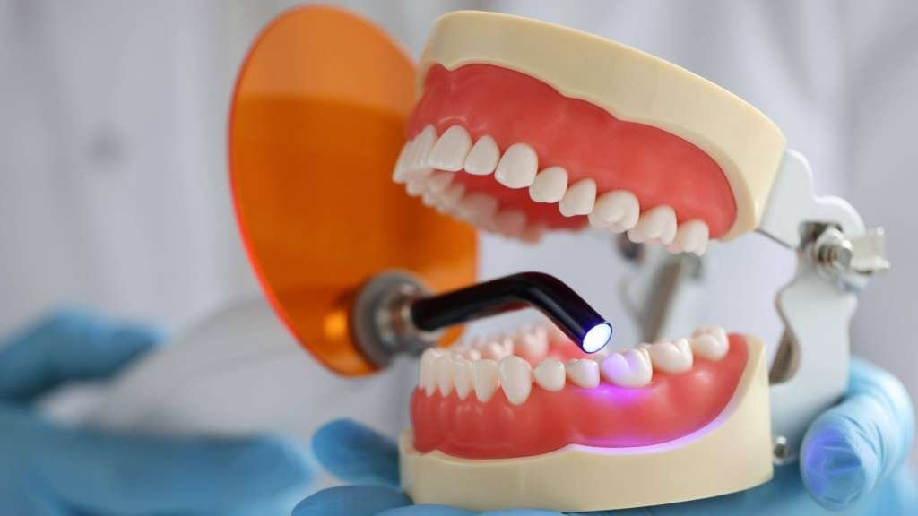 Appearance of small cavities and early tooth decay.