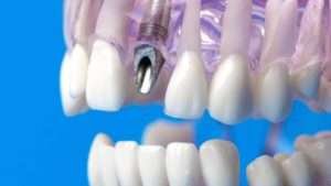 Guide to implant-supported dental solutions in Allen, TX.