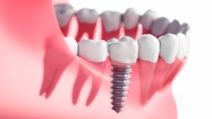 Various dental implant solutions available in Allen, TX.
