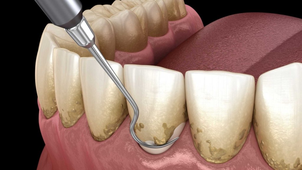 Effectiveness of periodontal cleaning for in-office teeth whitening.