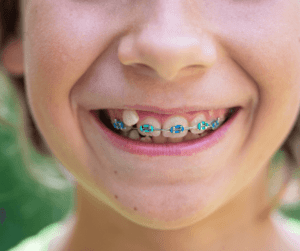 Ideal age for children to start orthodontic treatment.