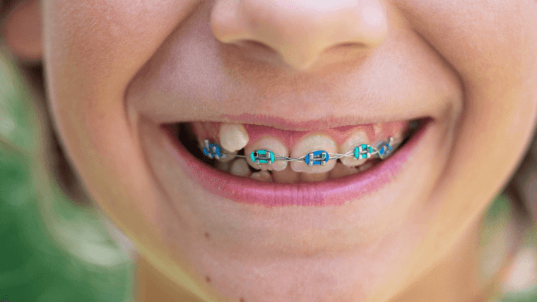 When to Start Your Child Orthodontic Treatment  in Allen, Texas?
