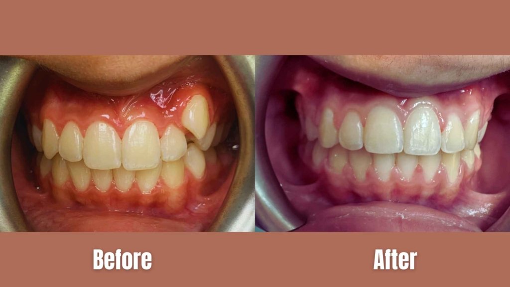 How FASTBRACES technology works for quicker teeth straightening.