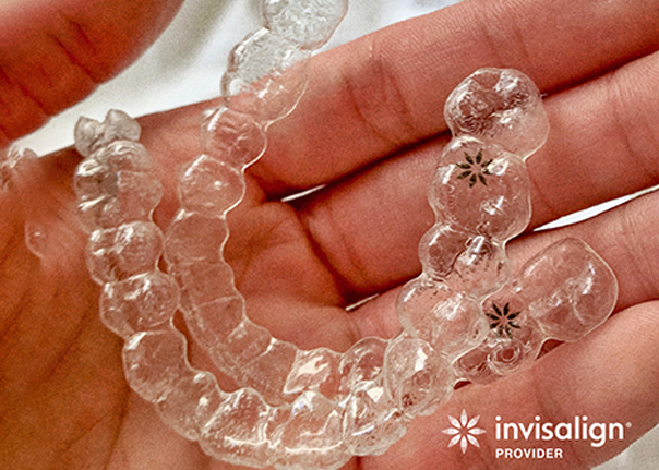 Transparent Invisalign aligners for orthodontic treatment.