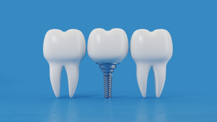 Maintaining Oral Health After Getting Dental Implants in Allen, TX