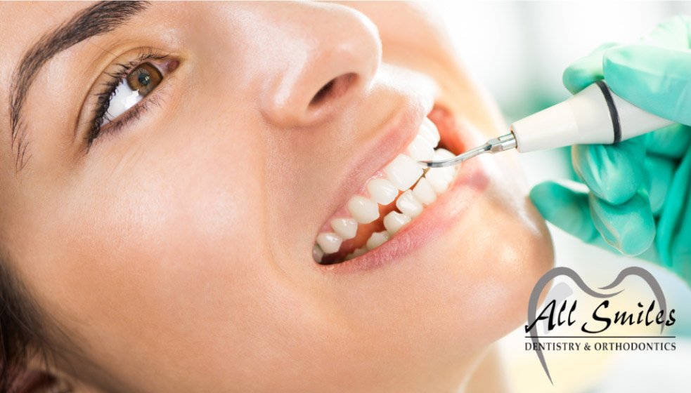 Different Types of Dental Cleaning: Explore Pros and Cons