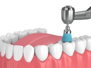 Advantages of deep teeth cleaning for oral health.