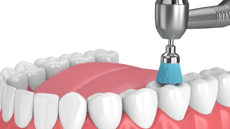 Benefits of Deep Teeth Cleaning That You Need to Know in 2024