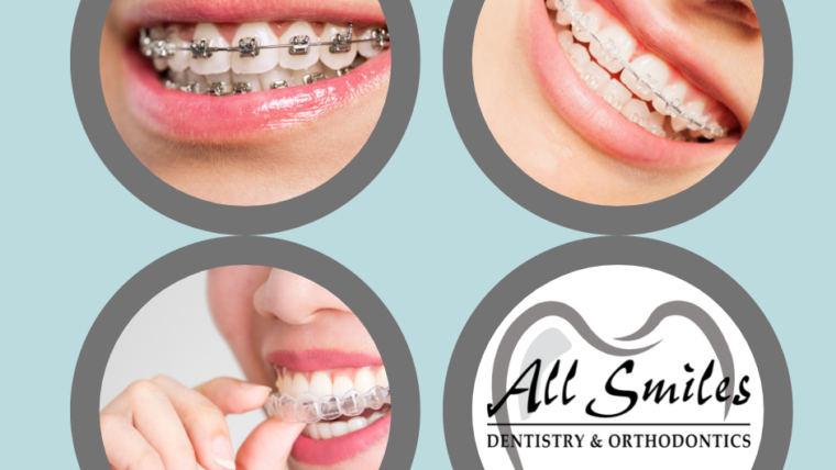 Orthodontic Braces: Types Explained & How They Work