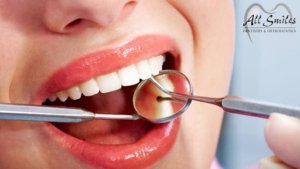 Step-by-step process of dental fillings.
