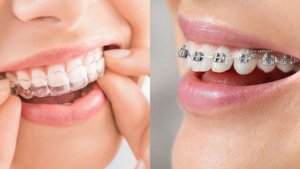 Comparison of Invisalign and dental braces for treatment.