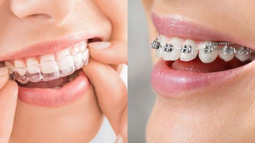 Comparison of Invisalign and dental braces for treatment.