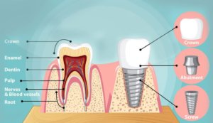 Overview of dental implant types and surfaces.