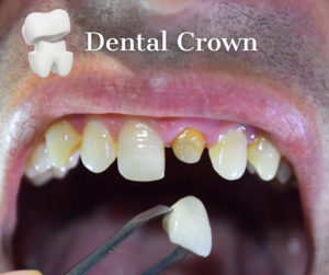 Understanding the dental crown procedure.