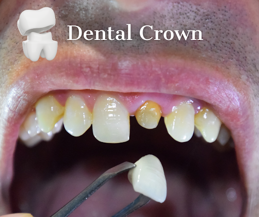Understanding the dental crown procedure.