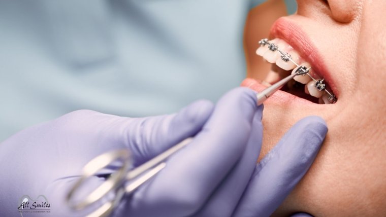 Understanding Orthodontics: Myths That Mislead Patients