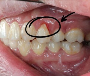 Causes, treatments, and prevention of gum recession.
